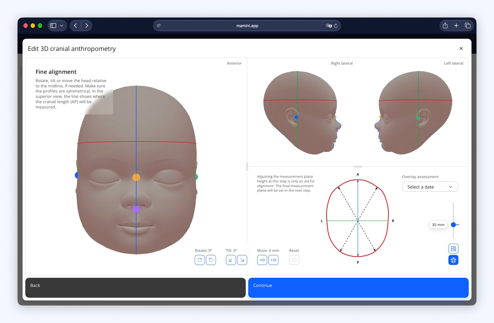 Fine alignment step of 3D cranial anthropometry, with the anterior view of the head, both profiles and the measurement plane contour with the diagonals.