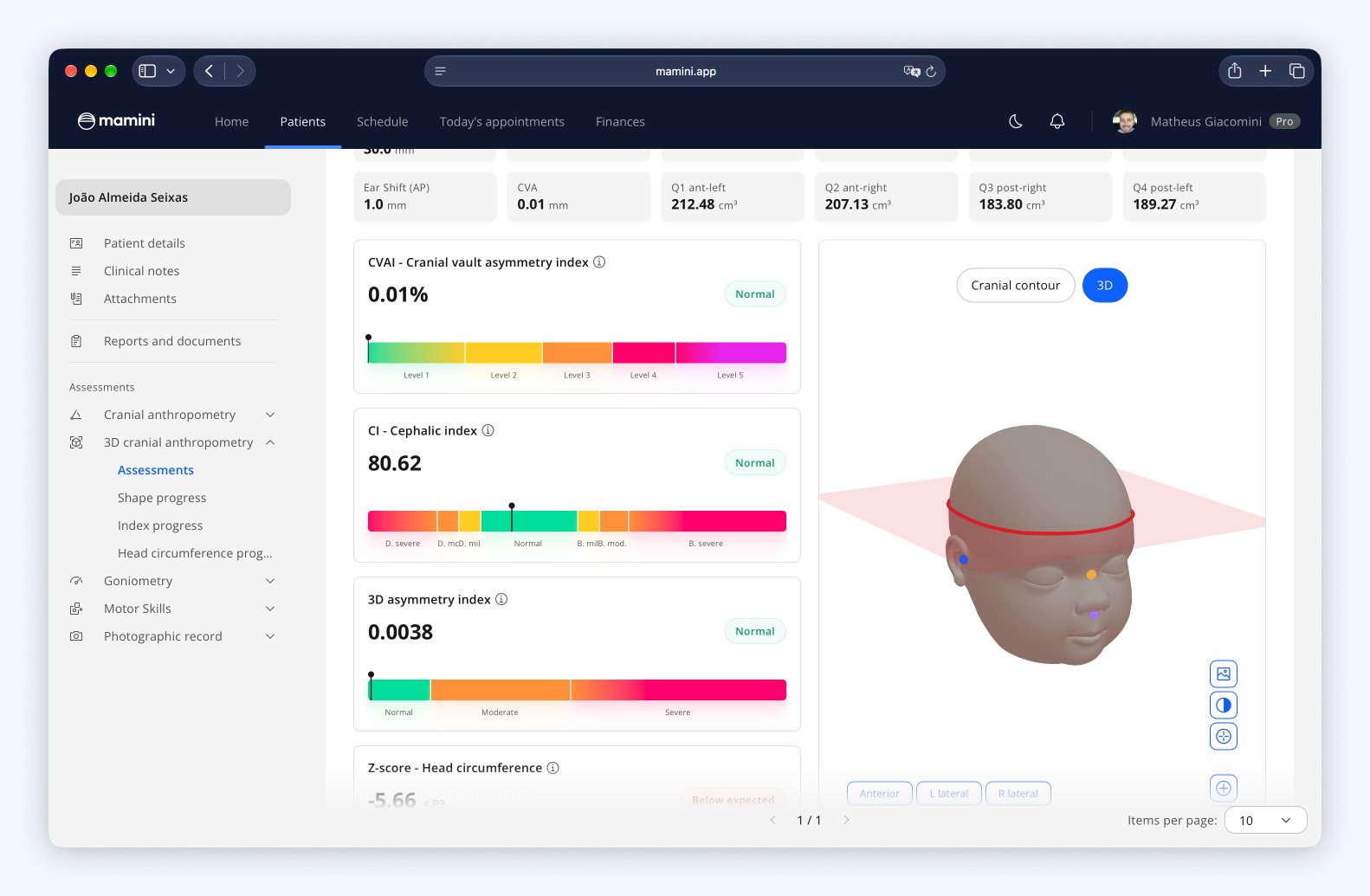 Mamini's 3D cranial anthropometry results screen, with the scanned head, the measurement plane in red and the measurement and index cards.